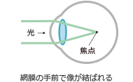 網膜の手前で像が結ばれる