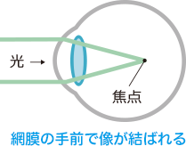 網膜の手前で像が結ばれる