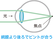 網膜より後ろでピントが合う